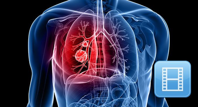 TriHealth On Call Lung Cancer Screening