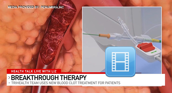Health Talk Live: Breakthrough Treatment for Blood Clots
