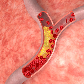 Is it Possible to Reverse Hardening of the Arteries?
