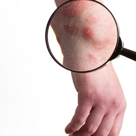 Dr. Pranav Sheth Answers Common Psoriasis Questions