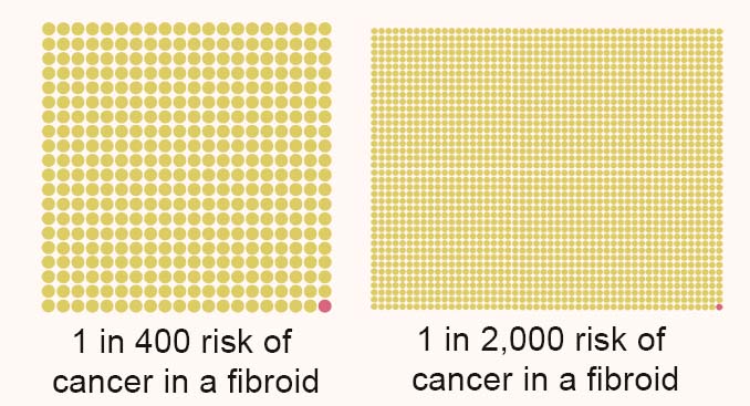 Fibroid Risk