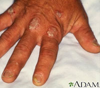 psoriasis on knuckle