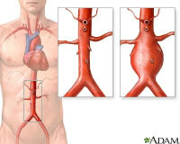 ADAM_aortic aneurysm _200x