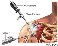 Shoulder Arthroscopy (ADAM)