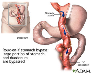 laparoscopic gastric bypass surgery-ADAM