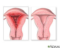 ADAM_abnormal menstrual periods_200x