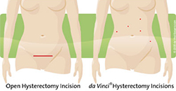 Hysterectomy comparison