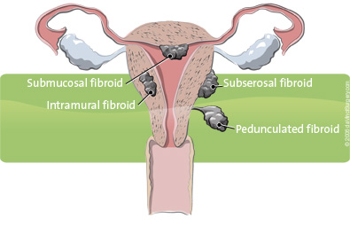 uterus fibroid types