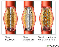 ADAM - Coronary artery balloon angioplasty_200x