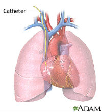 Cardiac Catheterization_200x