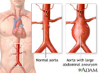 ADAM -  Aortic aneurysm_200x