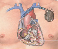 ADAM - implantable cardiac defibrillator