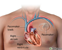 ADAM - pacemaker