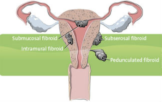 Uterine Fibroids_325x