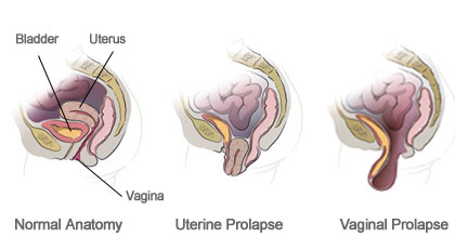 Normal anatomy, uterine prolapse, and vaginal prolapse