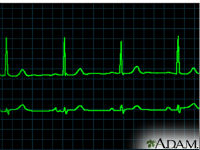 ADAM - heart conditions - bradycardia_200x