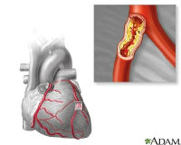 ADAM - heart conditions - atherosclerosis_200x