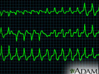 ADAM - heart conditions - ventricular tachycardia_200x