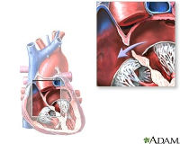 ADAM - heart conditions - atrial septal defect_200x