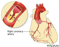 ADAM - heart conditions - coronary artery disease_200x160x