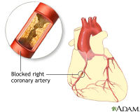 ADAM - heart conditions - blocked artery