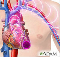 ADAM - heart attack symptoms_200x_190x