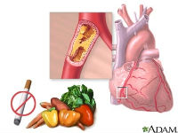 ADAM - heart conditions - heart disease_200x