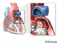 ADAM - heart conditions - left atrial myxoma_200x