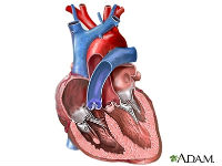 ADAM - heart conditions - heart valves_200x