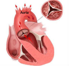 aortic stenosis_230x