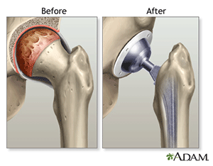 Hip Joint Replacement: Before and After
